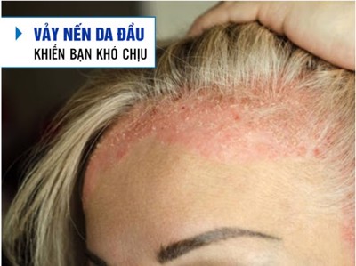 Vảy nến da đầu: Không còn ám ảnh nếu biết những thông tin này